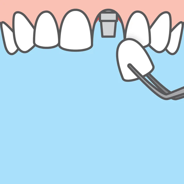 Blank banner Upper Single implant tooth illustration vector on b — Stock Vector