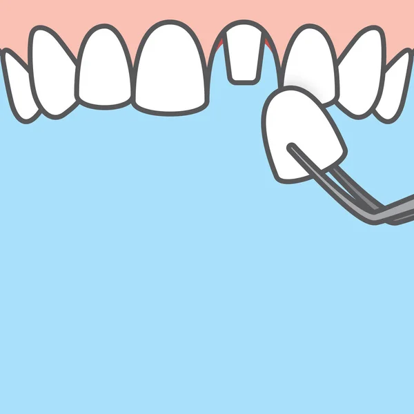 Mavi üzerine boş pankart Tek kaplama diş illüstrasyon vektörü — Stok Vektör