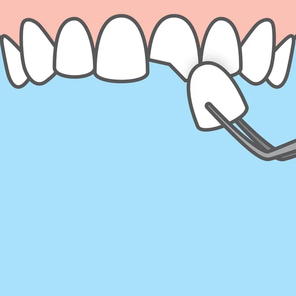 Blank banner Upper Veneer tooth illustration vector on blue back — Stock Vector