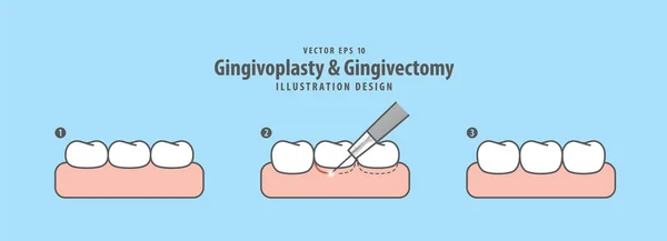 Gingivoplasty & Gingivectomy step electrosurgery cut gum off ill — Stock Vector
