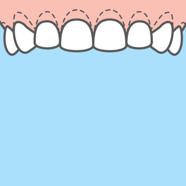 Boş pankart Üst Gingivoplasty & Gingivectomy işaretleme sakızı 