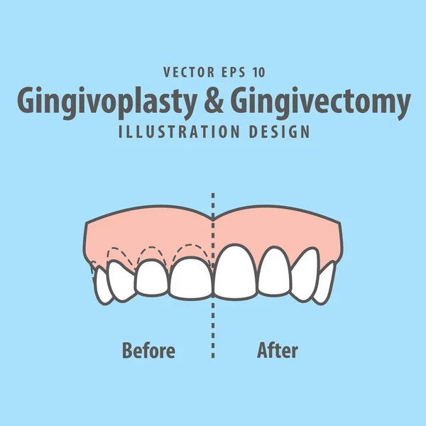Dişlerinin üst kısmını Gingivoplasti ve Gingivectomi ameliyatından önce karşılaştır — Stok Vektör