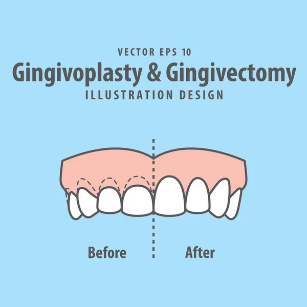 Confronta denti superiori Chirurgia della gengivoplastica e gengivectomia prima — Vettoriale Stock