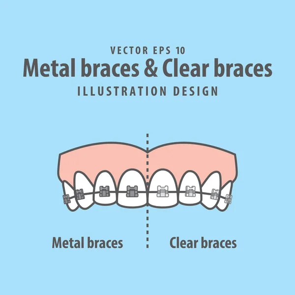 Metal aparat ortodontyczny zęby & Clear aparat ortodontyczny zęby (górny) porównanie illus — Wektor stockowy
