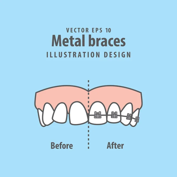 Comparar dientes superiores Tirantes metálicos antes y después de la ilustración v — Archivo Imágenes Vectoriales