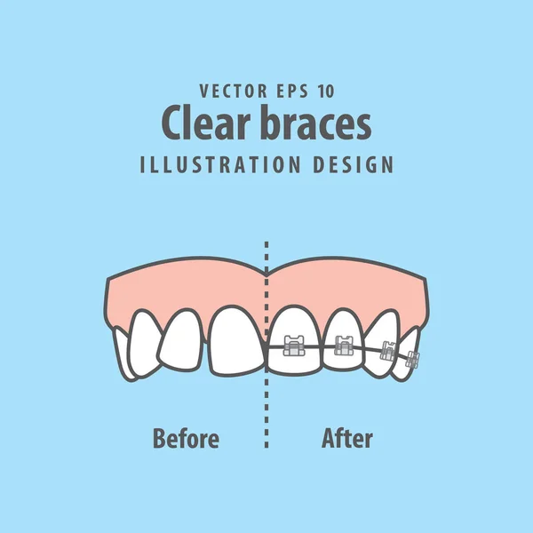 Порівняти верхні зуби Очистити брекети до і після ілюстрації v — стоковий вектор