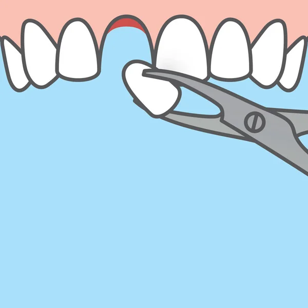 Tandutdragning, tandutdragning med pincett (övre) i — Stock vektor