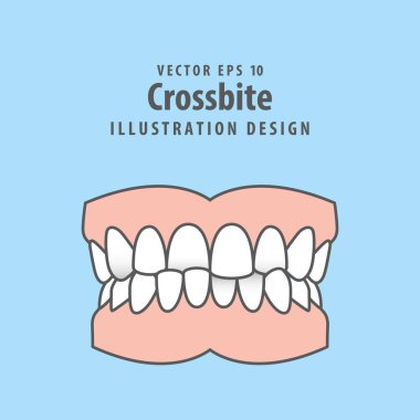 Dental crossbite teeth illustration vector design on blue background. Dental care concept. clipart