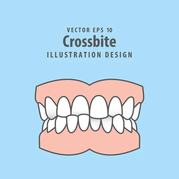 Οδοντική Crossbite Οδοντογλυφίδα Διανυσματική Σχεδίαση Μπλε Φόντο Έννοια Οδοντιατρικής Περίθαλψης — Διανυσματικό Αρχείο