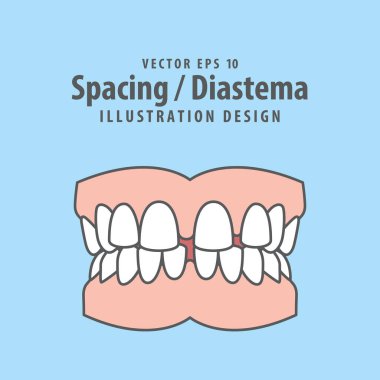 Mavi arka planda diş boşluğu veya diastema diş illüstrasyon vektör tasarımı. Diş sağlığı konsepti.