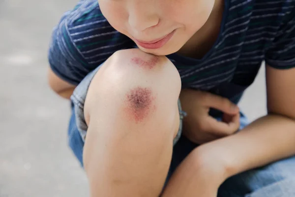 kid\'s knee after he fell down on pavement