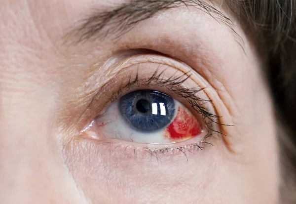 gözde subconjunctival kanama 