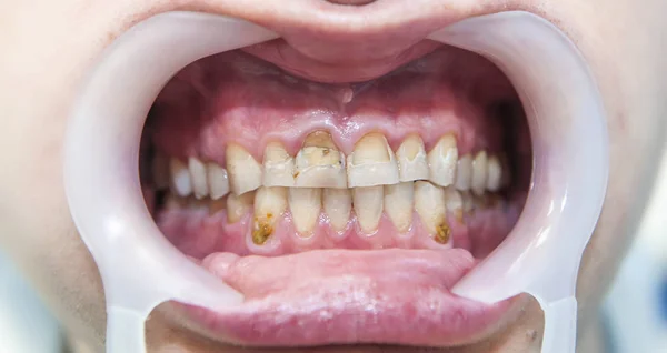 Dental fluorosis.  Metabolism dysfunction, — Stock Photo, Image