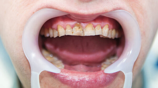 Close up of dental fluorosis