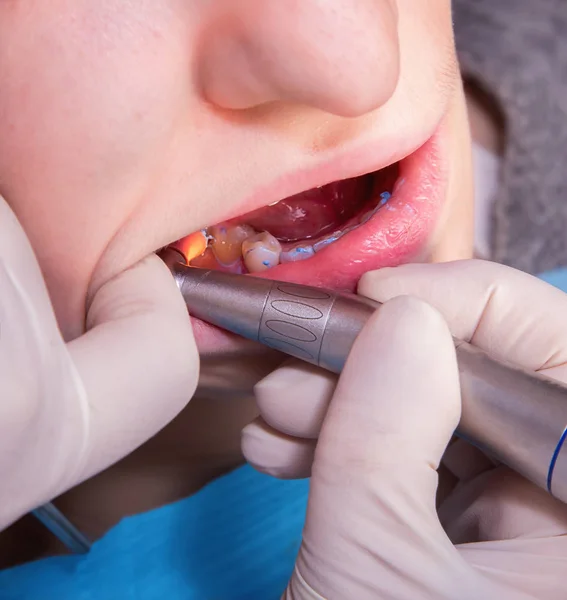 Tandläkare att göra patientens tänder hygien — Stockfoto