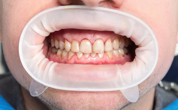 Diş florozis yakın çekim