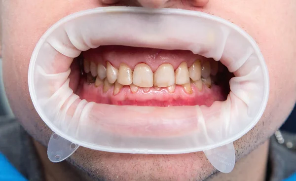 歯の弗素症のクローズ アップ — ストック写真