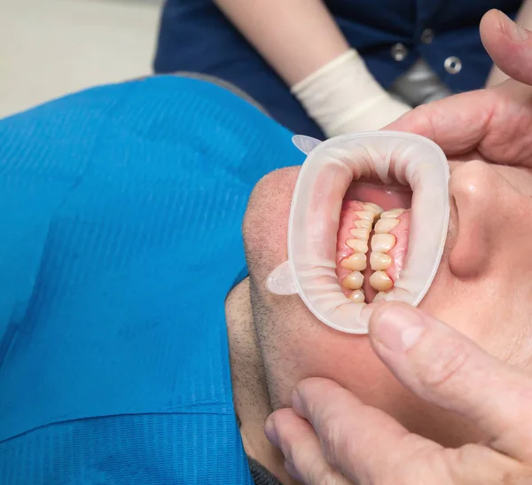 Närbild på dental fluoros — Stockfoto