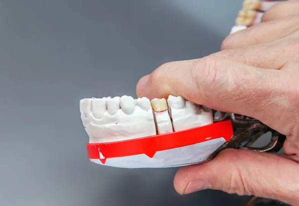 Mano dentista con modello dentale in ceramica — Foto Stock