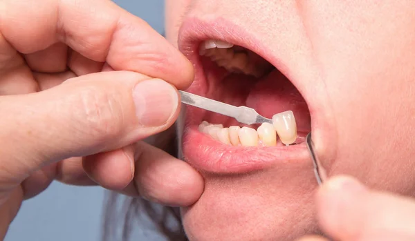 Dentist checking and selecting color of woman's teeth