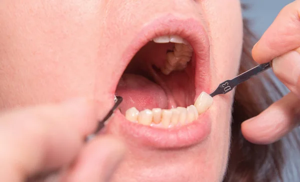 Controllo dentista e selezione del colore dei denti della donna — Foto Stock