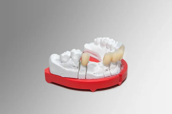 Modello dentale in gesso con denti in ceramica — Foto Stock