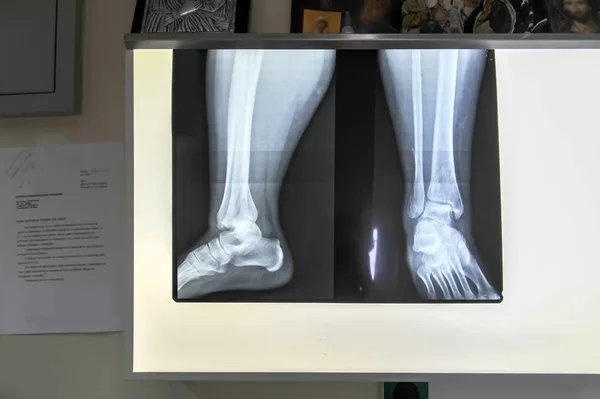 Medical feet bone radiography photo — Stock Photo, Image