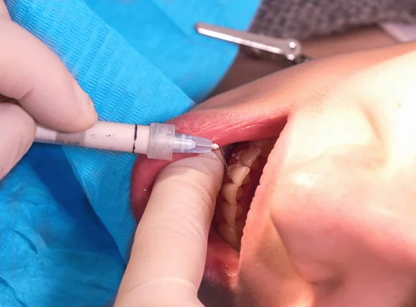 Tandläkarens händer med spruta behandling av patientens tänder — Stockfoto