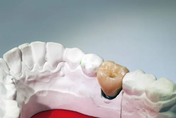 Modello dentale in gesso con dente in ceramica — Foto Stock