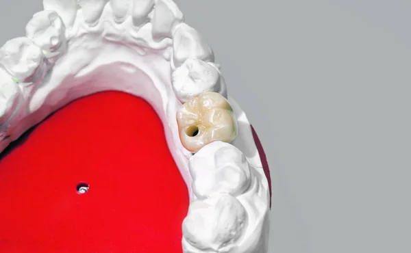 Modelo dental de gesso com dente cerâmico — Fotografia de Stock