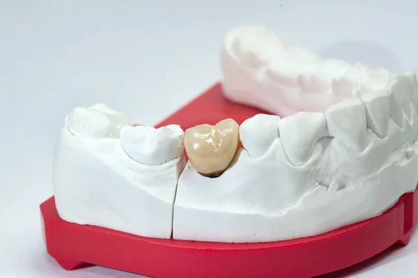 Modello dentale in gesso con dente in ceramica — Foto Stock