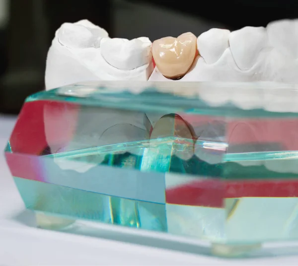 Гіпсова стоматологічна модель з керамічним зубом та скляною призмою — стокове фото