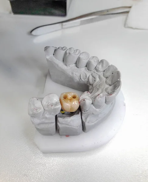 Gypsum dental model with ceramic tooth — Stock Photo, Image