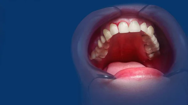 Mund mit blutendem Zahnfleisch auf blauem Hintergrund — Stockfoto