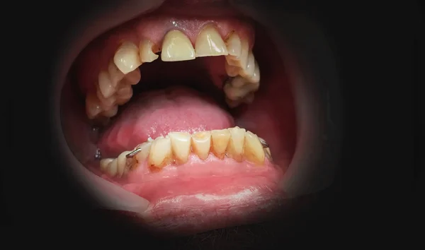 Boca com cárie dentes danificados em um fundo escuro — Fotografia de Stock