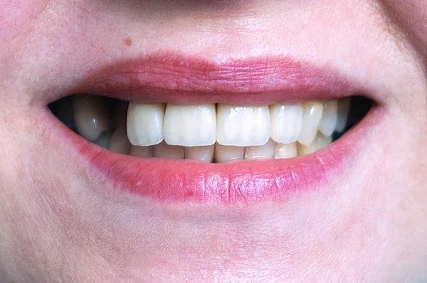 Mouth with four prosthetic upper teeth — Stock Photo, Image