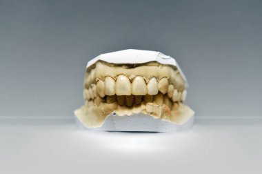 Alçı diş model dört seramik diş ile 