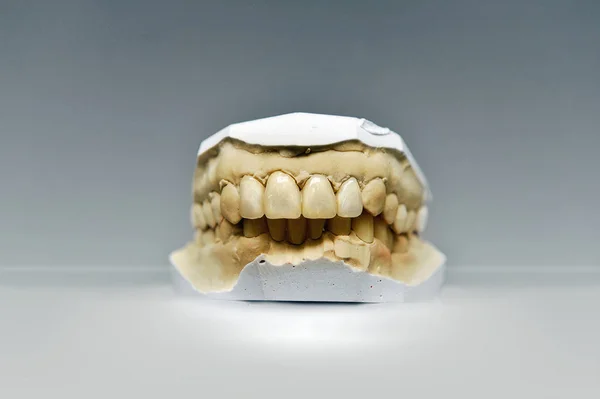 Гипсовая зубная модель с четырьмя керамическими зубами — стоковое фото