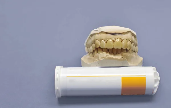 Modello dentale in gesso con quattro denti in ceramica — Foto Stock