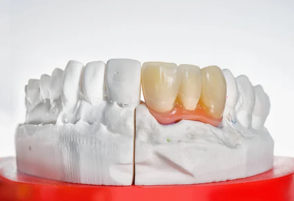 Colpi tecnici di protesi dentaria su una protesi dentale — Foto Stock