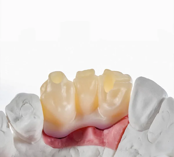 Technical shots of tooth prosthesis on a dental prothetic labora — Stock Photo, Image