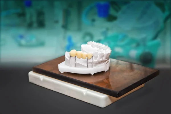 Fotos técnicas del modelo de yeso con dientes de cerámica — Foto de Stock