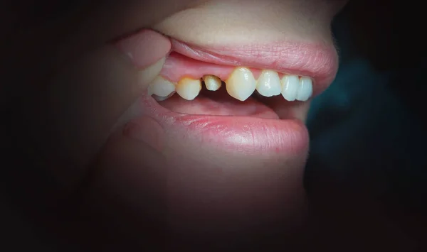 Dientes de mujer con un diente preparado para prótesis — Foto de Stock