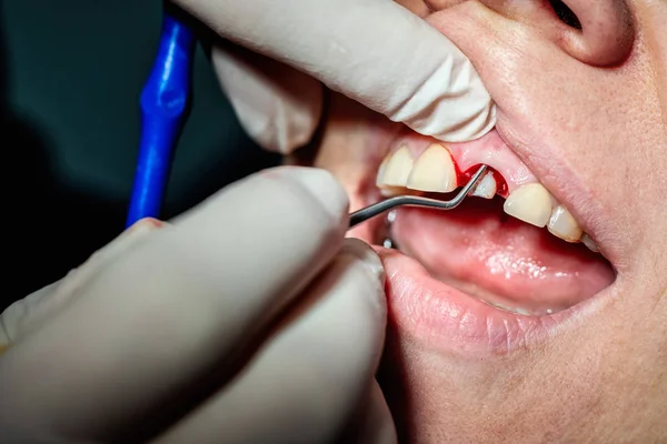 Blödande tandkött runt protesen tand och läkare händer med — Stockfoto