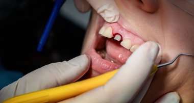 Protez diş ve doktor ellerinde kanayan diş etleri var. 