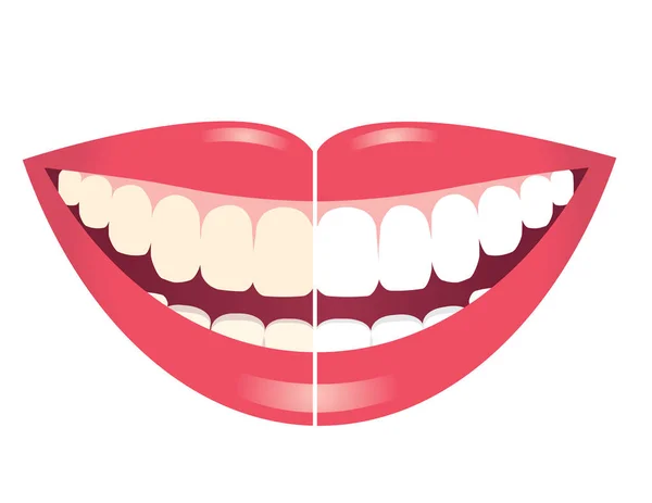 Whitening teeth on white background — Stock Vector