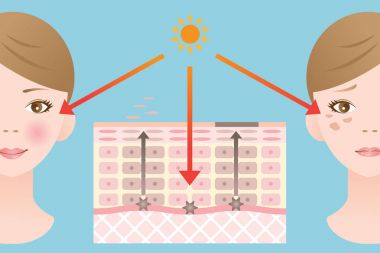 Cilt nokta mekanizması