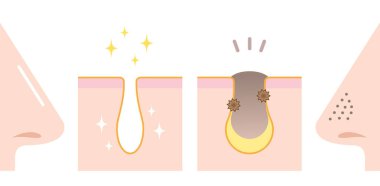 önce ve sonra burun üzerinde gözenek açarken