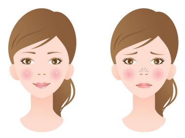 unclogging pore treatment on female face clipart