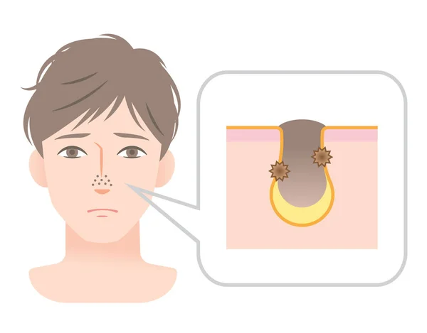 Verstopte poriën op neus van jonge mens gezicht — Stockvector